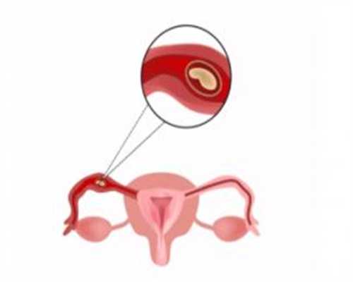 助孕中心：输卵管堵塞可以做试管婴儿吗